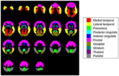 Using CT Data to Improve the Quantitative Analysis of 18F-FBB PET Neuroimages